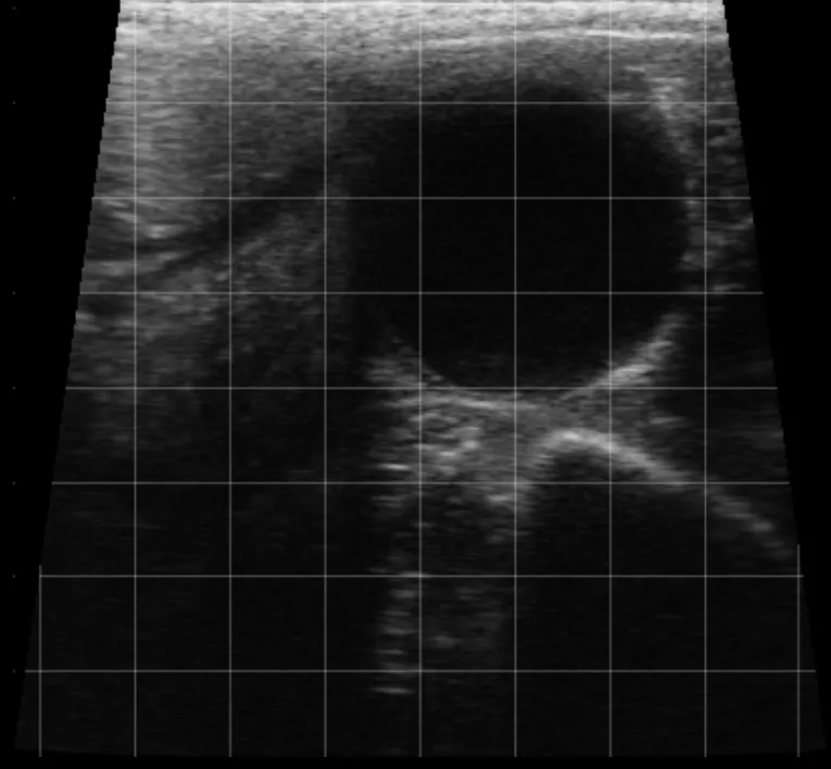 Follicular Cyst 1